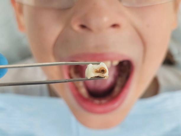 Best Emergency Root Canal Treatment in Arlington, NE
